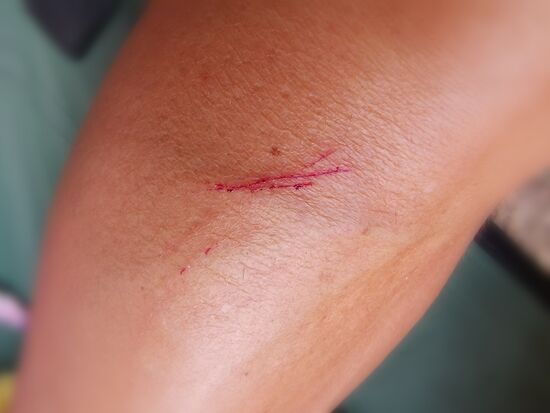 Spuren der Verwüstung auf meinem Schienbein 