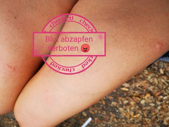 puuuh - diese Mücken - die Pflatschen verschwinden zwar relativ schnell wieder, aber bis einer verschwunden ist, sind 2 neue da grrrrr