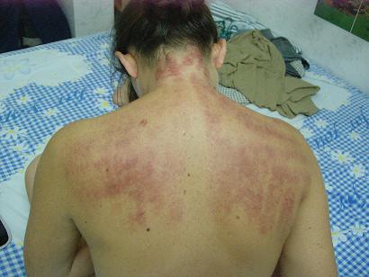 Ergebnis einer vietnamesichen Massage