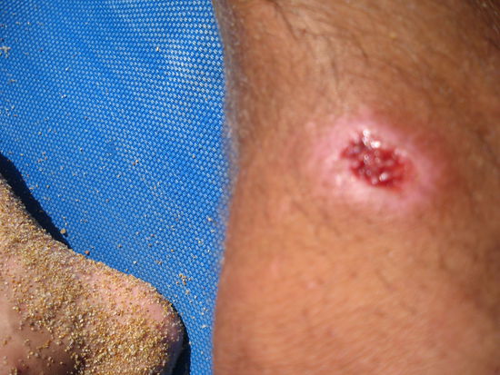 KLEINE bLESSUREN ...BOESES sKINBOARD!!!