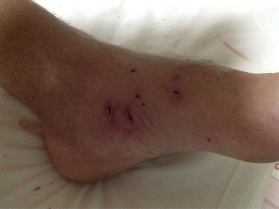 Fuß mit Bisswunden