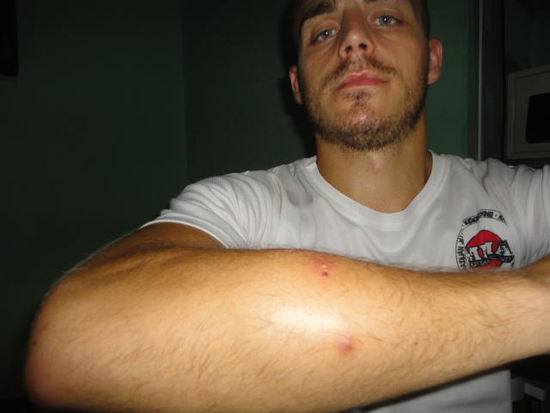 Benjamins geschwollener Arm.