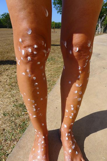 Dies ist keine indigene Kunst. Mit weissen Cremetupfen sieht es noch lustig aus, die roten Placken und Blasen darunter waren nicht witzig. Der restliche Körper wird erst gar nicht zur Schau gestellt.