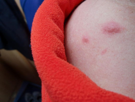 Das Ergebnis von zustechenden Plagegeistern!