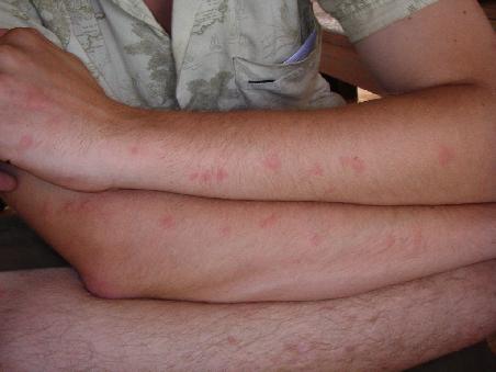 37 Stiche auf EINEM Arm