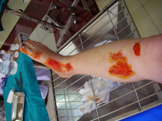 nenee, kein blut. nur jod 