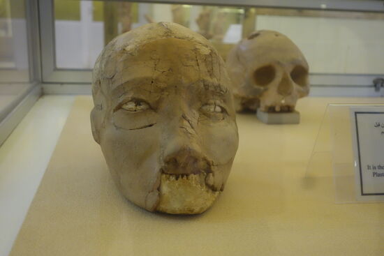 Schädel mit Operationslöchern - 
Fundort: Jericho - frühe Bronzezeit 2200 - 2000 v.Chr.