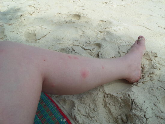 Mein zerstochenes Fuesschen - juckt echt bestialisch 