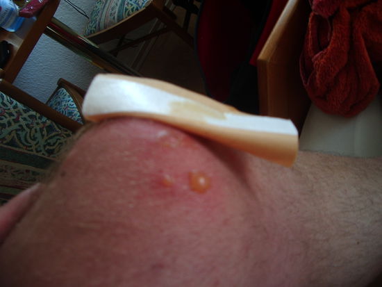 Achtung!!!!! Es ist eckelig!!!!!