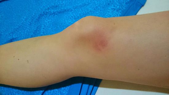 So seh ich aus nach dem Surfen, beim Surfen gibts leider noch nicht, dafür mittlerweile noch mehr Miniverletzungen