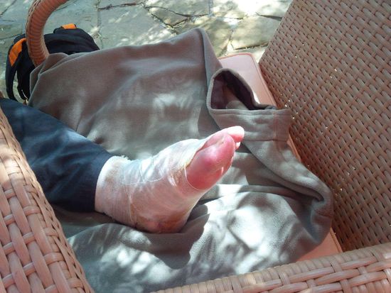 Das war das Ergebnis und es wird behauptet, dass das Zeug unter der Mullbinde Ziegenkacke ist, die für solche Verletzungen das Wundermittel wäre.