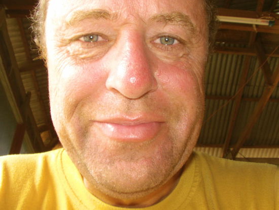 Ich habe mir heftig das Gesicht verbrannt.