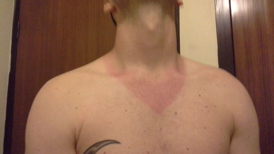 Torbens Bräune nach dem heutigen Tag - Bügeleisen-Look