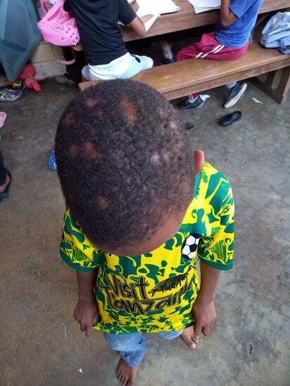 Dieser Junge leidet an einer Hautkrankheit. Andere haben andere Hautkrankheiten  
Da die Bedingungen im Waisenhaus so beengt sind, ist die Chance auf Ausheilung gering.