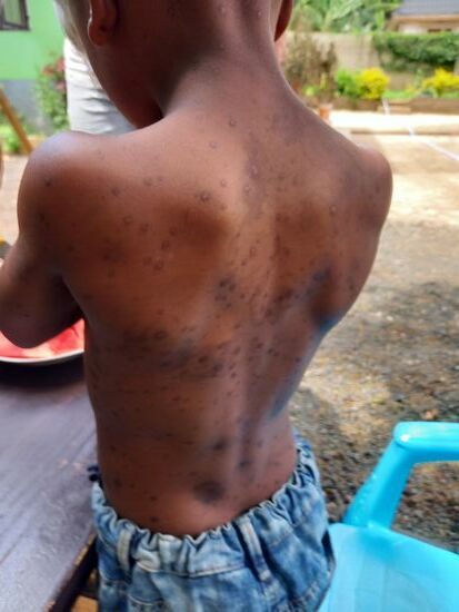 Als er sein neues T-Shirt anzieht sehe ich die abgeheilten Wunden der Hühnerpocken. Ich habe auch Bilder gesehen,  wie es aussah als Peter ihn aus dem Waisenhaus Kellys mit zu sich nahm.   Das sind Bilder die ich niemandem zumuten möchte.