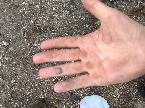 Blutige und wässrige Blasen von 13 Stunden Pistenspaß.