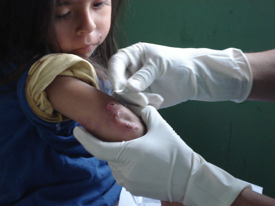 La uta (Leishmanasis)