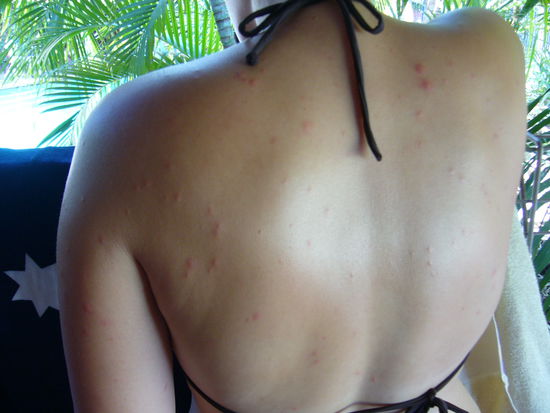 So sah mein Ruecken 2 Tage nach der Mueckenattacke aus
