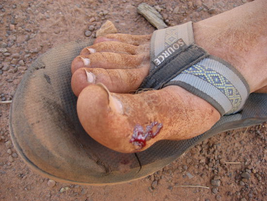 Die etwas verunstaltete Zehe von Travis