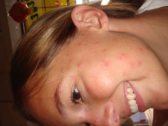 Sorry kann das Fotot nicht drehen. Mein armes verstochenes Gesicht, jedoch nur einseiteig