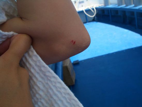 Der Fischbiss in Tamaras Ellenbogen