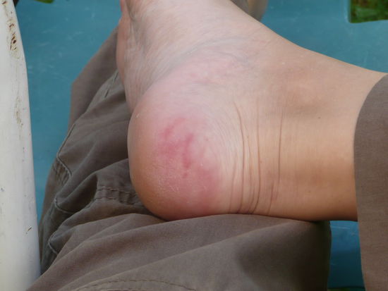 Meine Ferse nach 10 Tagen.