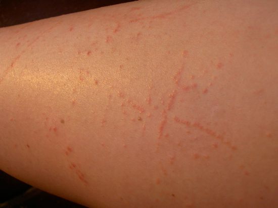 Und so sehen Beine 1 Woche nach dem Verirren im Dschungel von Ko Tao aus!