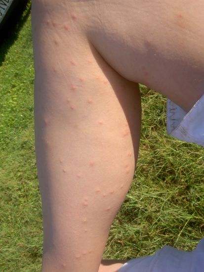 Melanie mit ihrer australische Beulenpest, die dann auch tatty und mich heimsuchte. Juckt unglaublich!