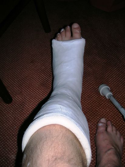 Und hier der Grund des Abbruches ---> Wadenbeinbruch ---> Versorgung in Vigo (Spanien)