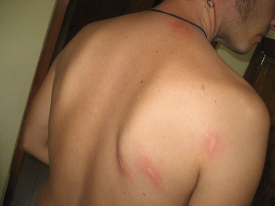 das hier sind vermutlich moskitostiche, doch es koennten auch andere tiere (im bett?...) gewesen sein...