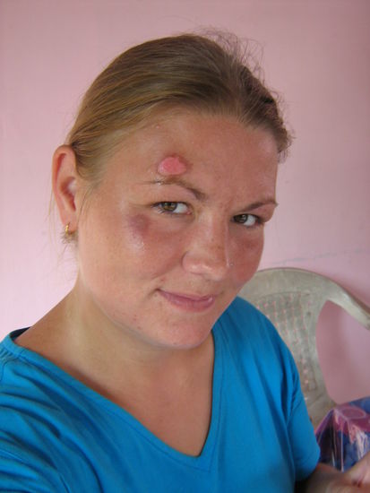 Nach dem Wellenunfall beim zweiten Aufenthalt in Agonda. Wurde von einer Welle mitgerissen und mit dem Kopf voraus auf den Meeresboden geschleudert. Die Schramme ist inzwischen schon verheilt und nur noch ein rosa Fleck zu sehen.