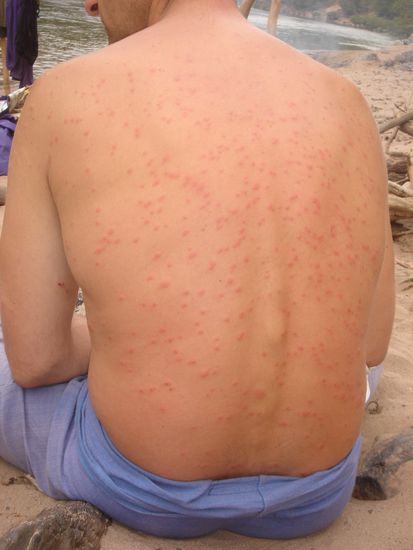 So sah mein Ruecken aus nachdem ich ohne T-shirt Bambus geerntet habe. Und ich mich gewundert was da so juckt.