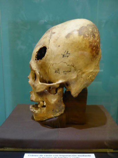 das Schönheitsideal wurde in den ersten Jahren des Babys geformt.
Das Loch zeigt ausserdem, dass schon in dieser Zeit Operationen am Kopf vorgenommen wurden. Vielfach wurde die Schädeldecke mit einer Goldplatte zugemacht.