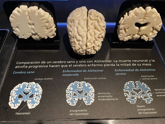 Vom gesunden zum Alzheimer-Kranken Hirn