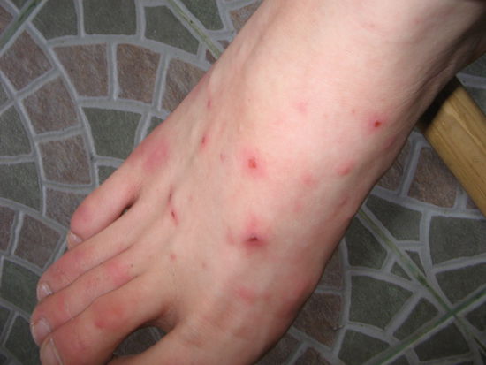 Meine Mückenstiche. Das sieht auf dem Foto viel harmloser aus, als es eigentlich war. Tagsüber konnte ich mich ja noch einigermaßen zusammenreißen, dass ich sie nicht aufkratze, aber in der Nacht bin ich oft aufgewacht und hatte blutige Füße und Fingernägel...