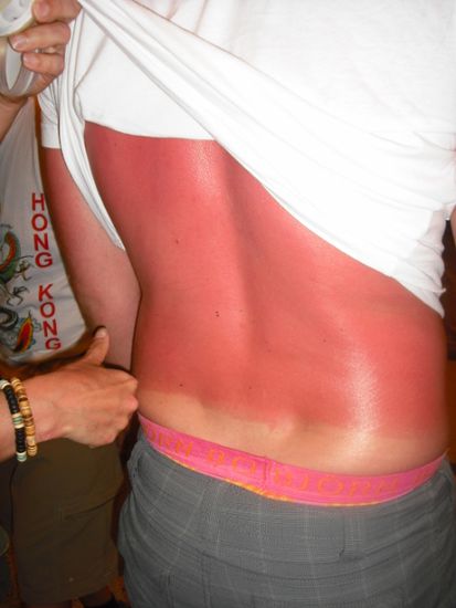 selber Schuld wenn man Sonnencremegegner ist