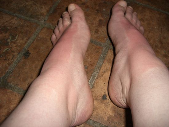 Fuß-Sonnenbrand ... kommt durch den Blitz net so krass rüber wie es war... everyone was shouting "Oh my god, it looks so bad"