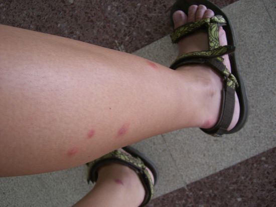 Chrissis Beine. Trotz Moskitonetz und Autan