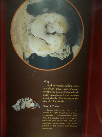 ﻿Eine Vergrößerung von Karies befallenem Zahn. Die Parodontitis erspare ich euch...