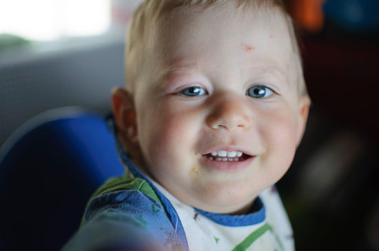 Rote Flecken und ein geschwollenes Auge von den Insekten.