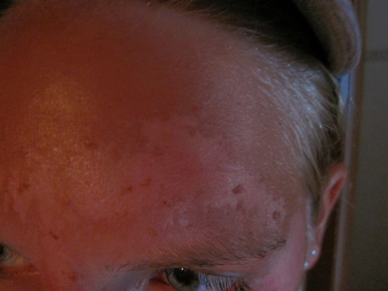 Aua...mein Sonnenbrand 