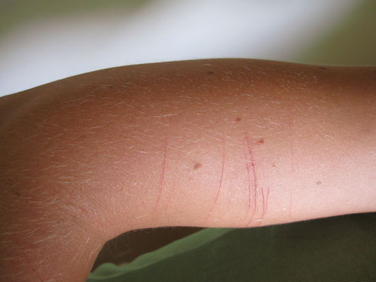 Aua... und so sieht ein Arm aus, wenn man mit dem Fahrrad in die Buesche faehrt...