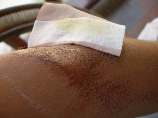 Arm nach 24 Stunden... aua...
