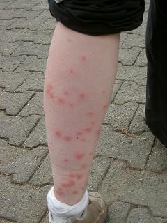 Nicoles Bein nach der Mueckeninvasion