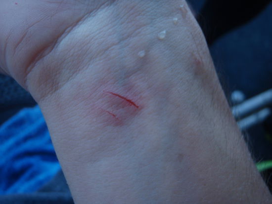 Verletzung von den Korallen.
Tragt Handschuhe!!!