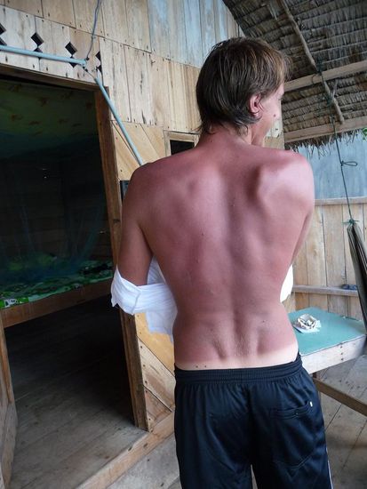 Ein richtig heftiger Sonnenbrand... ich spuerte dies noch 3 Tage lang.