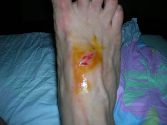 Wunderversorgen nach Rezeptur des RTL Dschungel-Arztes Dr. Bob.........aehhhhh nein Dr. Haring: Man laeuft nachdem man seine Flip-Flops beim Unfall in den Abwasserkanal verloren hat (sehe es als Opfergabe an meine Schutzgoetter an ........barfuss quer durch Ubud nach Hause. Man reinigt die Wunde peinlich genau mit Wasser........Schmiert Jod und Wundsalbe drauf und schreit zweimal ganz lt. AUA....um dem Brennschmerz ein Ventil zu verpassen............und fertisch..........die Wunde ist bereits heute am vernarben 