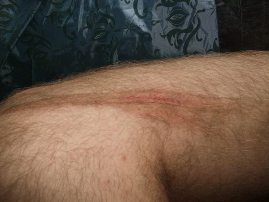 Ein Schnitt am Bein.