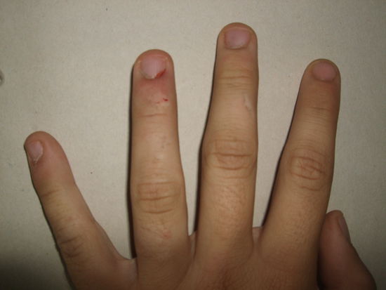 Geschürfte Finger, die Robin nichtmehr bewegen konnte.