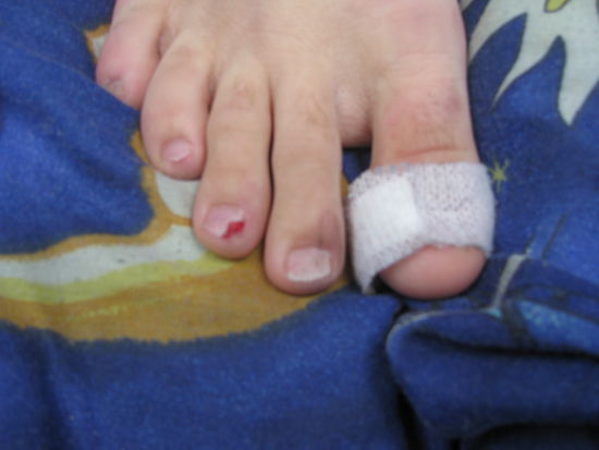 Robins abgeschlagener Zehennagel.